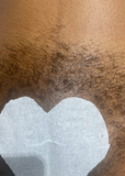 Hair Removal